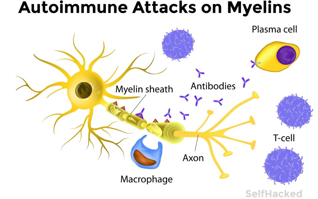 Oxidative Stress, Multiple Sclerosis: What you Need to Know!